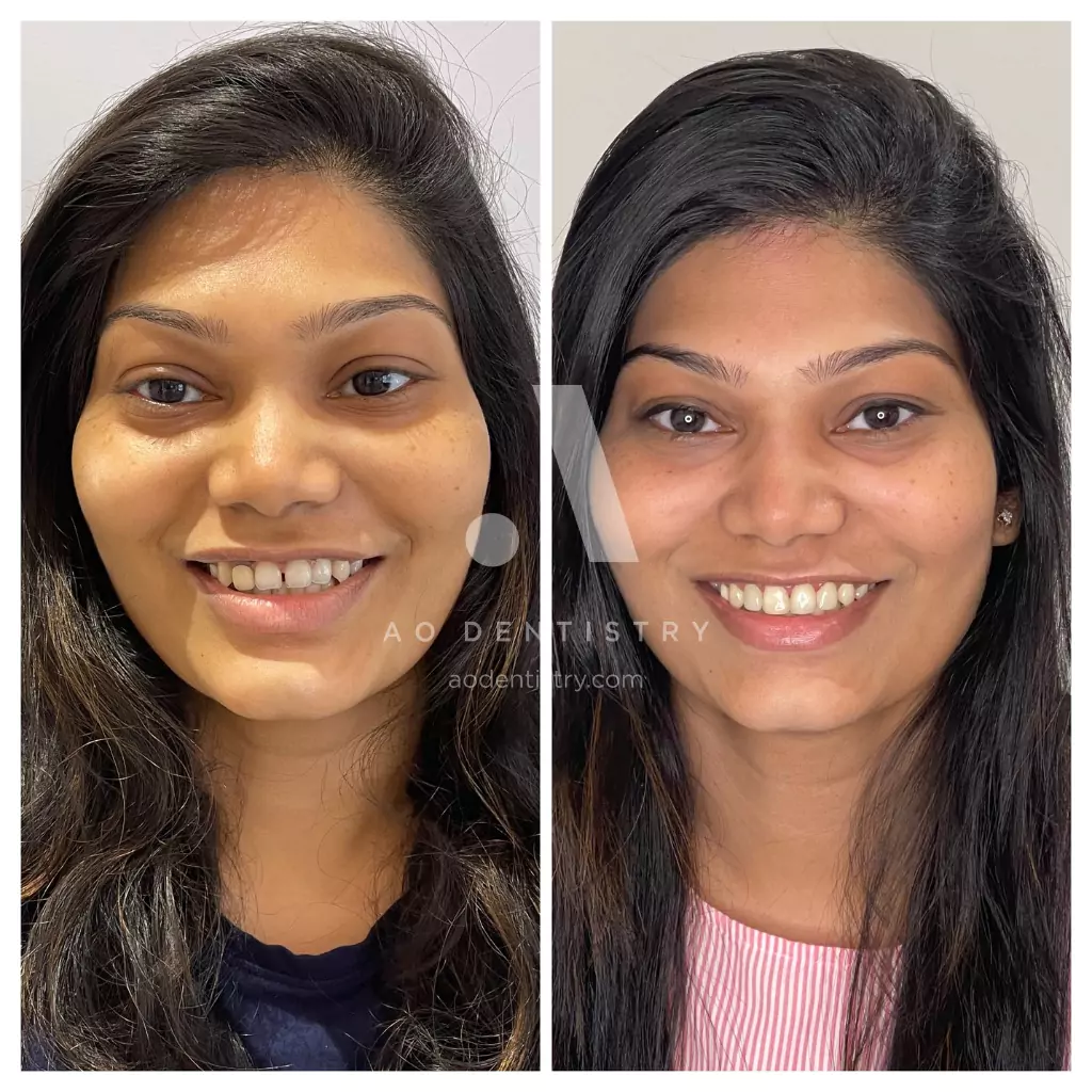 ao-dentistry-veeners-case-photo-10-666d8d5da7b55