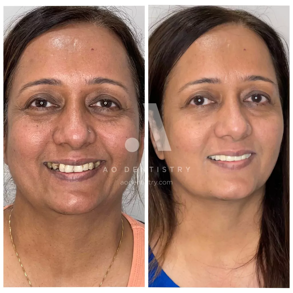 ao-dentistry-veeners-case-photo-11-666d8d60382c5