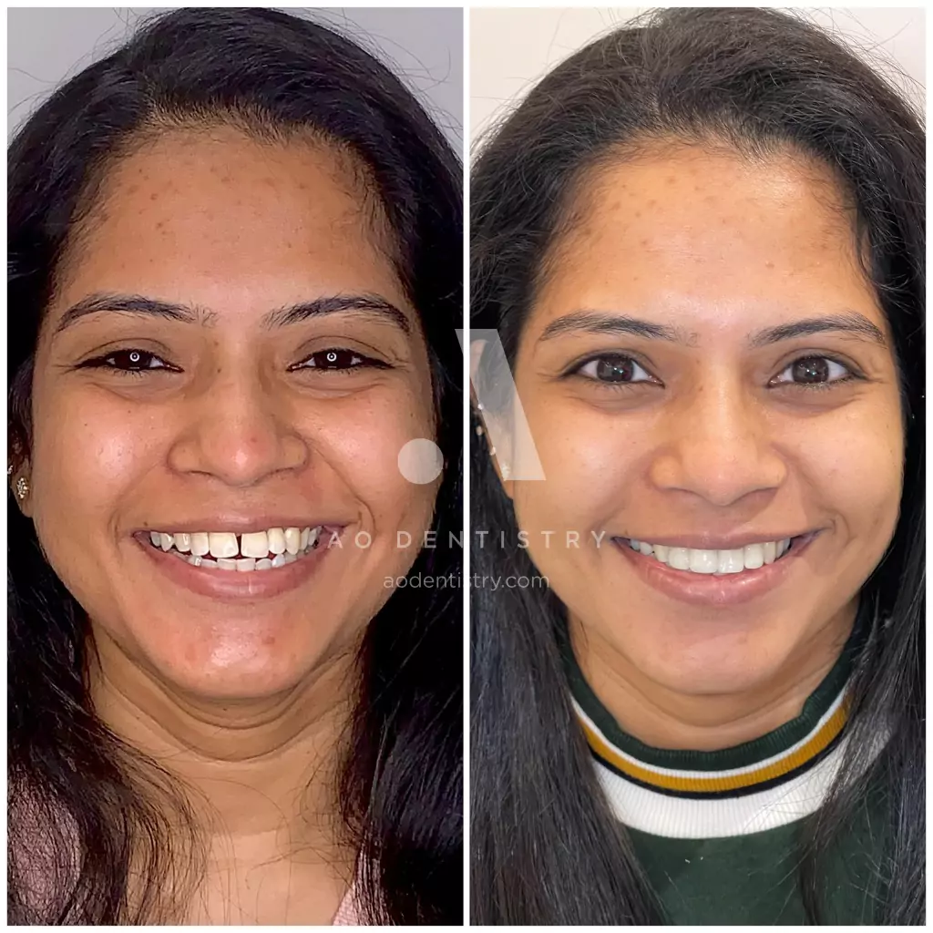 ao-dentistry-veeners-case-photo-2-666d8d524abb0