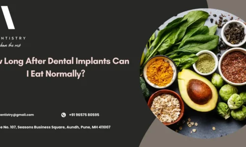 How Long After Dental Implants Can I Eat Normally