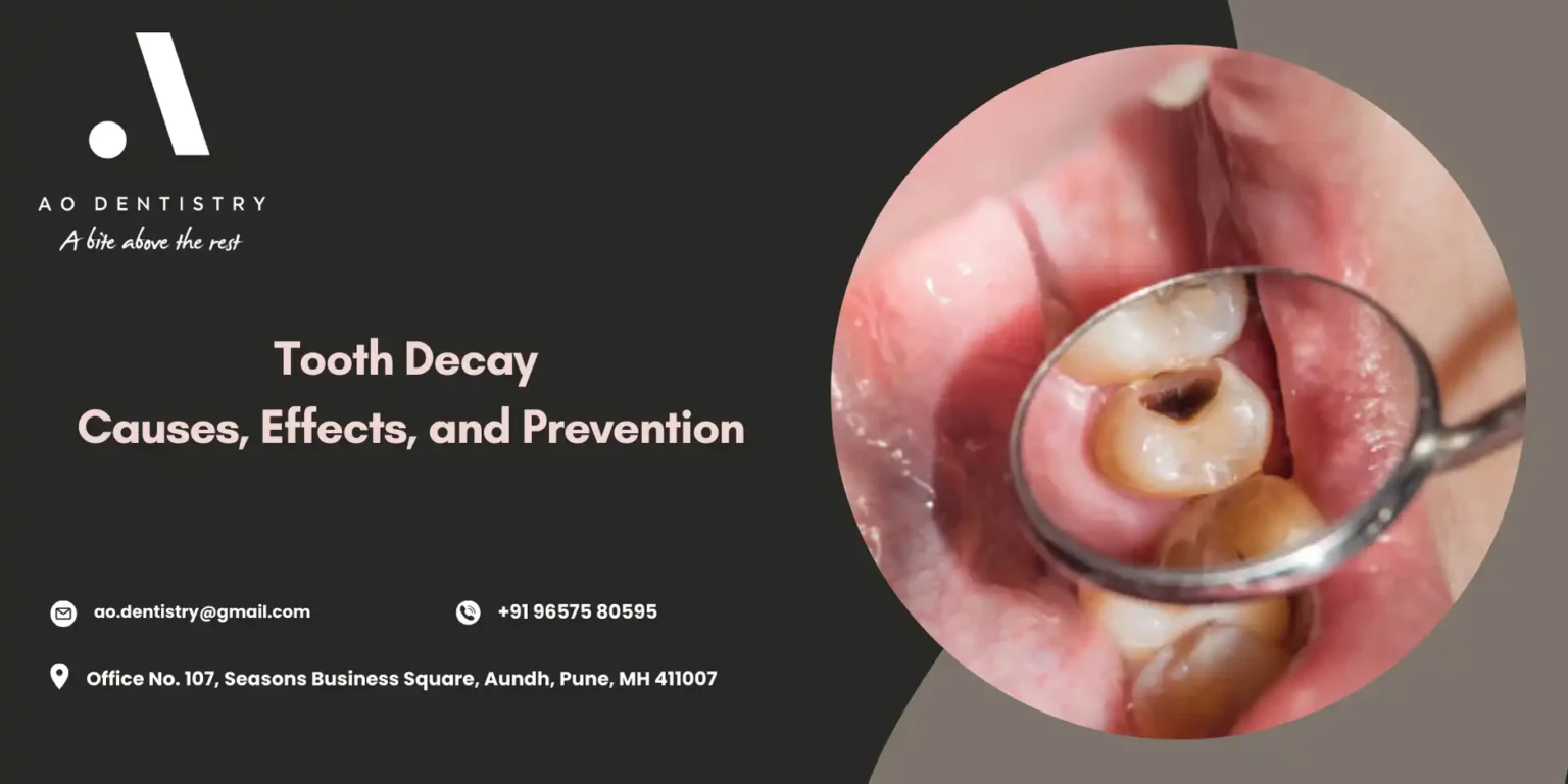 What Causes Cavities & Tooth Decay
