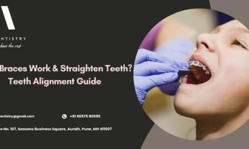 How Braces Work