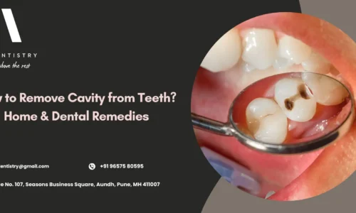 How to Remove Cavity from Teeth