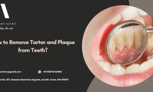 How to Remove Tartar and Plaque from Teeth