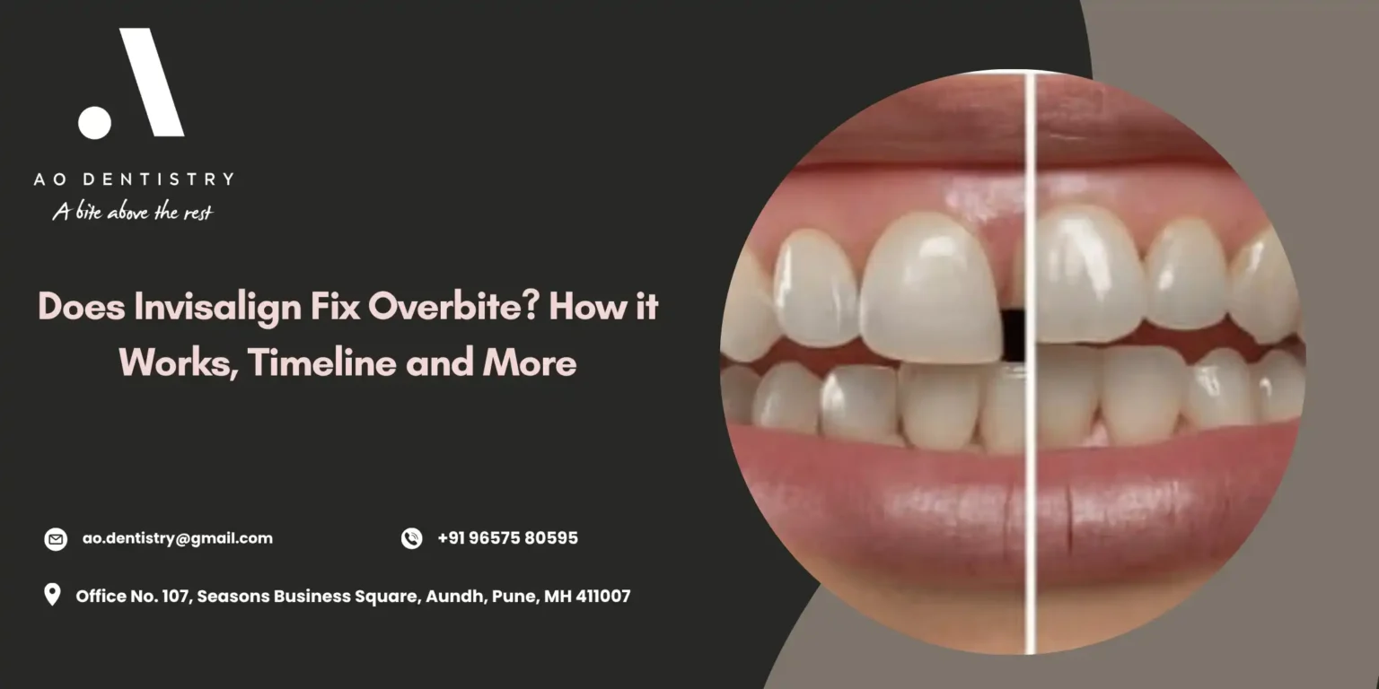 Does Invisalign Fix Overbite