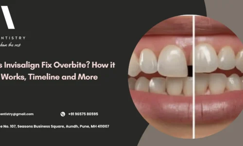 Does Invisalign Fix Overbite