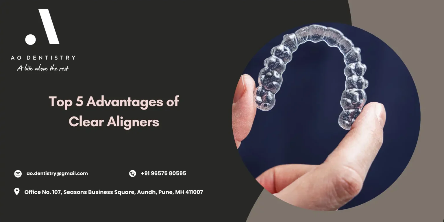 Advantages of Clear Aligners